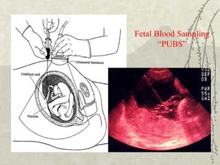 Fetal Blood Sampling
“PUBS”

 