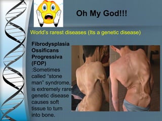World’s rarest diseases (Its a genetic disease)
Fibrodysplasia
Ossificans
Progressiva
(FOP)
:Sometimes
called “stone
man” syndrome,
is extremely rare
genetic disease
causes soft
tissue to turn
into bone.
Oh My God!!!
 