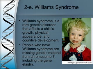 2-e. Williams Syndrome
• Williams syndrome is a
rare genetic disorder
that affects a child's
growth, physical
appearance, and
cognitive development.
• People who have
Williams syndrome are
missing genetic material
from chromosome 7,
including the gene
elastin.
 