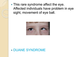 .
 This rare syndrome affect the eye.
Affected individuals have problem in eye
sight, movement of eye ball.
 DUANE SYNDROME
 