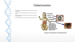 Galactosemia
 Galactosemia is a rare disorder that affects the body's ability to break down a food sugar
called galactose.
 The body breaks down lactose into galactose and glucose and uses these sugars for
energy.
 Most people with galactosemia are missing an enzyme (called GALT) that helps further
break down galactose.
 Defects in galactose metabolism cause toxic chemicals to build up in cells of the body.
 