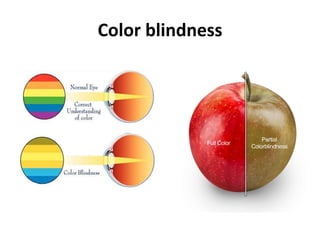 Color blindness
 