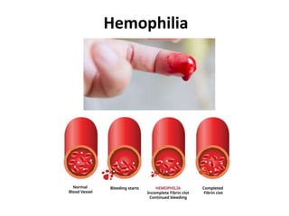 Hemophilia
 