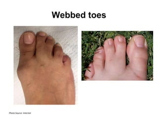 Webbed toes
Photo Source: Internet
 