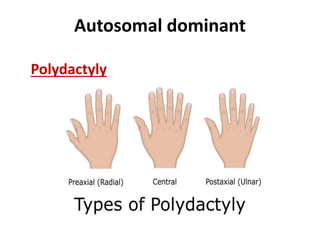 Autosomal dominant
Polydactyly
 