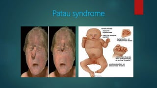 Patau syndrome
 