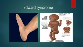 Edward syndrome
 