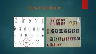 Down Syndrome
 