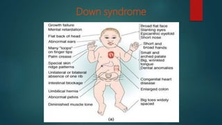 Down syndrome
 