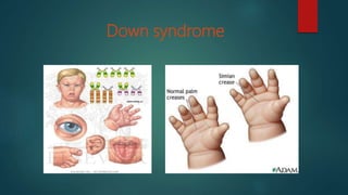 Down syndrome
 