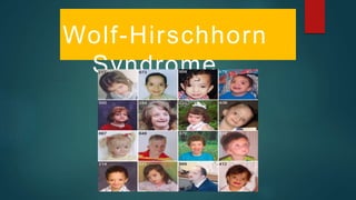 Wolf-Hirschhorn
Syndrome
 
