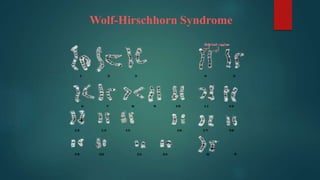 Wolf-Hirschhorn Syndrome
 
