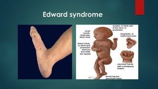 Edward syndrome
 