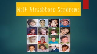 Wolf-Hirschhorn Syndrome
 