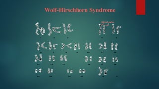 Wolf-Hirschhorn Syndrome
 