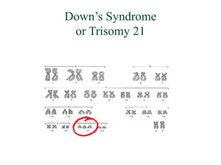 Down’s Syndrome
 or Trisomy 21
 