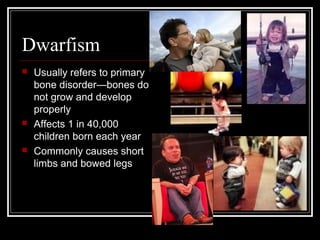 Dwarfism






Usually refers to primary
bone disorder—bones do
not grow and develop
properly
Affects 1 in 40,000
children born each year
Commonly causes short
limbs and bowed legs

 