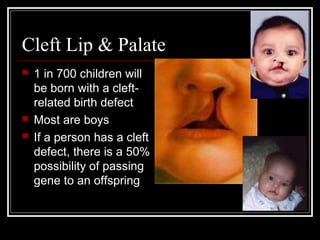 Cleft Lip & Palate





1 in 700 children will
be born with a cleftrelated birth defect
Most are boys
If a person has a cleft
defect, there is a 50%
possibility of passing
gene to an offspring

 