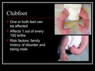 Clubfoot






One or both feet can
be affected
Affects 1 out of every
100 births
Risk factors: family
history of disorder and
being male

 