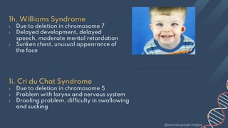 1h. Williams Syndrome
› Due to deletion in chromosome 7
› Delayed development, delayed
speech, moderate mental retardation
› Sunken chest, unusual appearance of
the face
1i. Cri du Chat Syndrome
› Due to deletion in chromosome 5
› Problem with larynx and nervous system
› Drooling problem, difficulty in swallowing
and sucking
@sources:google images
 
