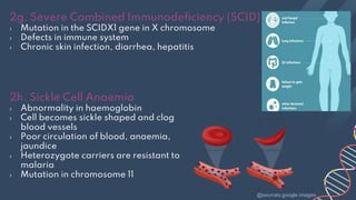 2h. Sickle Cell Anaemia
› Abnormality in haemoglobin
› Cell becomes sickle shaped and clog
blood vessels
› Poor circulation of blood, anaemia,
jaundice
› Heterozygote carriers are resistant to
malaria
› Mutation in chromosome 11
2g. Severe Combined Immunodeficiency (SCID)
› Mutation in the SCIDX1 gene in X chromosome
› Defects in immune system
› Chronic skin infection, diarrhea, hepatitis
@sources:google images
 
