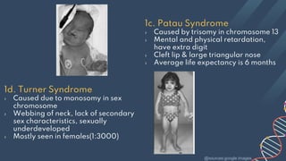 1c. Patau Syndrome
› Caused by trisomy in chromosome 13
› Mental and physical retardation,
have extra digit
› Cleft lip & large triangular nose
› Average life expectancy is 6 months
1d. Turner Syndrome
› Caused due to monosomy in sex
chromosome
› Webbing of neck, lack of secondary
sex characteristics, sexually
underdeveloped
› Mostly seen in females(1:3000)
@sources:google images
 