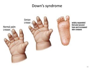 Down’s syndrome
58
 