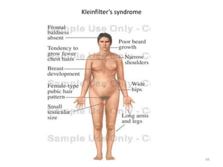 Kleinfilter’s syndrome
66
 