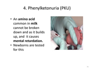 4. Phenylketonuria (PKU)
• An amino acid
common in milk
cannot be broken
down and as it builds
up, and it causes
mental retardation.
• Newborns are tested
for this
74
 