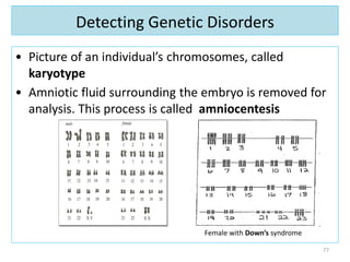 Detecting Genetic Disorders
• Picture of an individual’s chromosomes, called
karyotype
• Amniotic fluid surrounding the embryo is removed for
analysis. This process is called amniocentesis
77
Female with Down’s syndrome
 