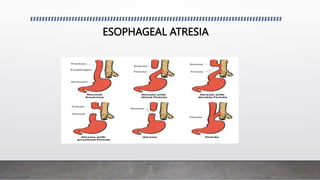 ESOPHAGEAL ATRESIA
 