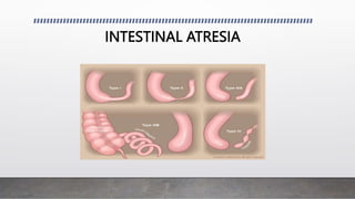 INTESTINAL ATRESIA
 