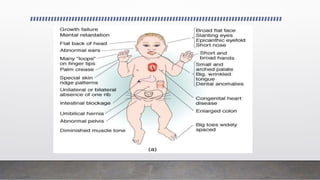 GENETIC DISORDERS.pptx pathology genetic malformations