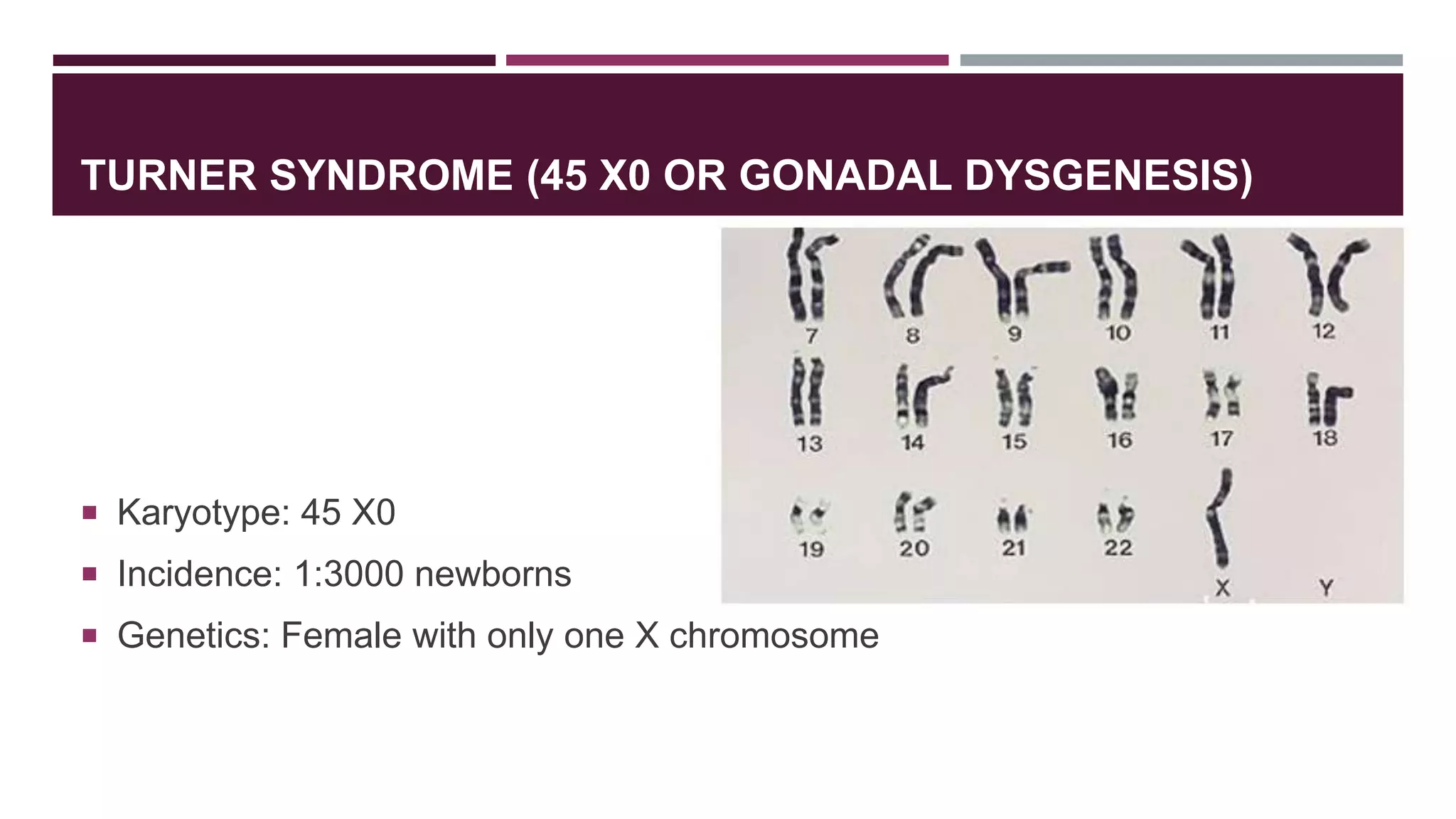 TURNER SYNDROME (45 X0 OR GONADAL DYSGENESIS)
 Karyotype: 45 X0
 Incidence: 1:3000 newborns
 Genetics: Female with only one X chromosome
 