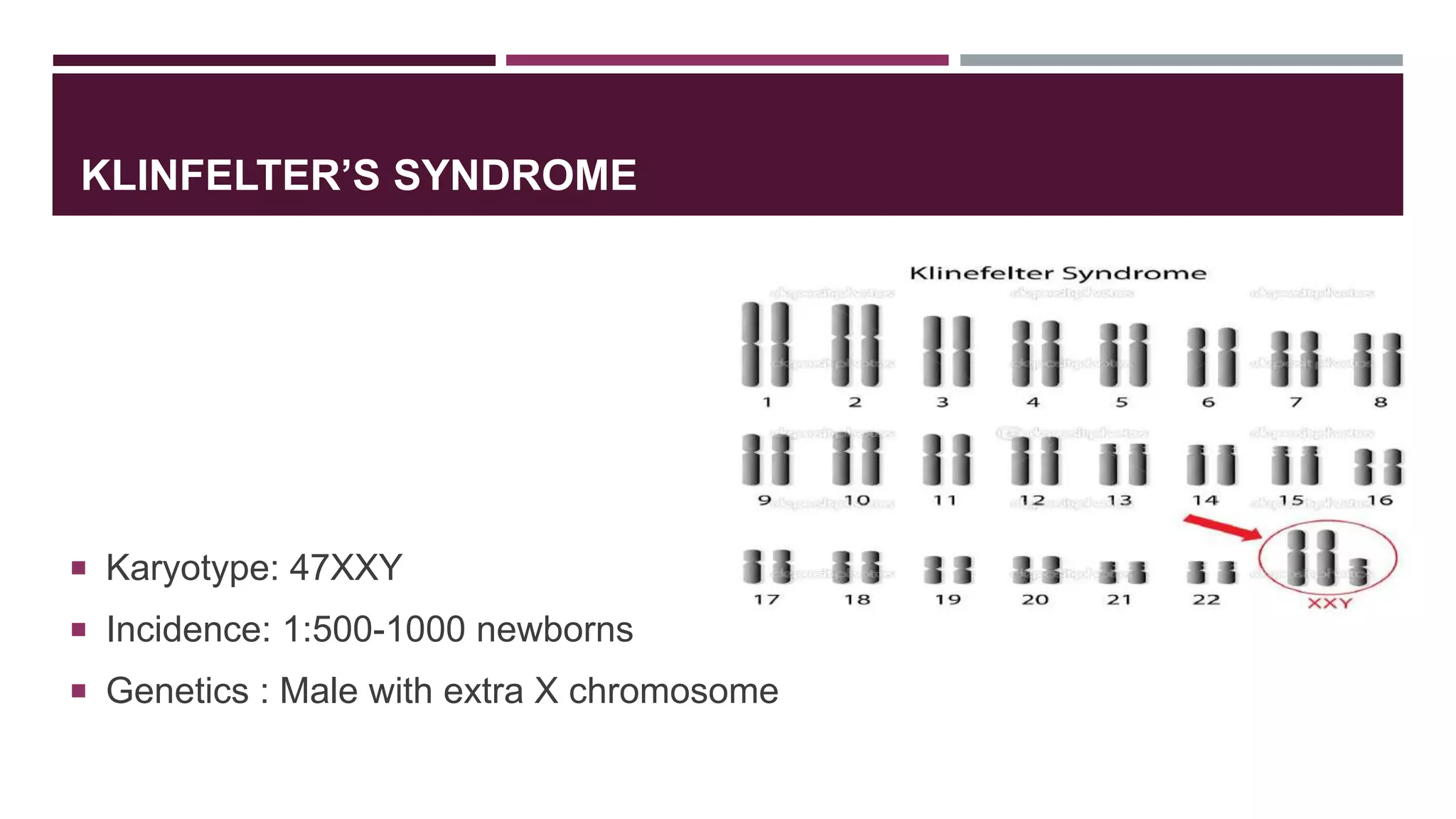 KLINFELTER’S SYNDROME
 Karyotype: 47XXY
 Incidence: 1:500-1000 newborns
 Genetics : Male with extra X chromosome
 