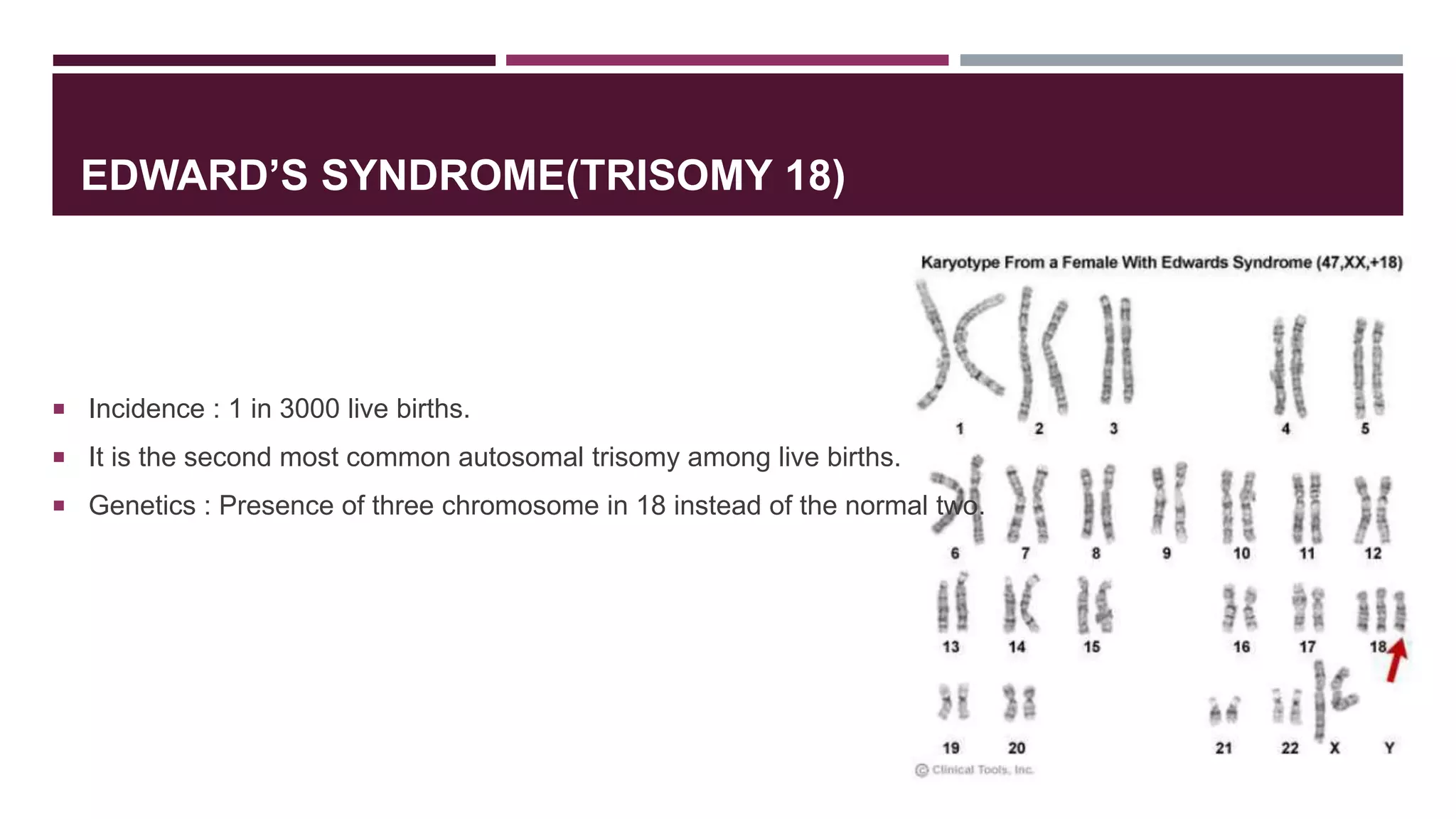 EDWARD’S SYNDROME(TRISOMY 18)
 Incidence : 1 in 3000 live births.
 It is the second most common autosomal trisomy among live births.
 Genetics : Presence of three chromosome in 18 instead of the normal two.
 