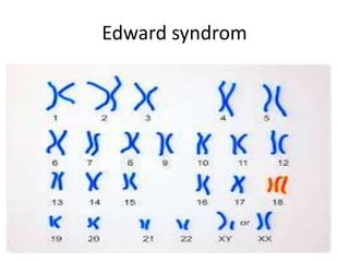 Edward syndrom
 