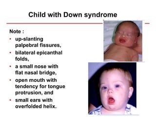 Child with Down syndrome
Note :
• up-slanting
palpebral fissures,
• bilateral epicanthal
folds,
• a small nose with
flat nasal bridge,
• open mouth with
tendency for tongue
protrusion, and
• small ears with
overfolded helix.
 