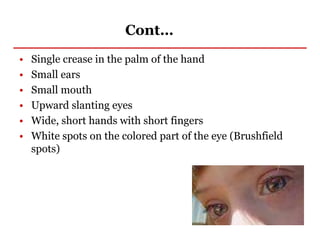 Cont…
• Single crease in the palm of the hand
• Small ears
• Small mouth
• Upward slanting eyes
• Wide, short hands with short fingers
• White spots on the colored part of the eye (Brushfield
spots)
 