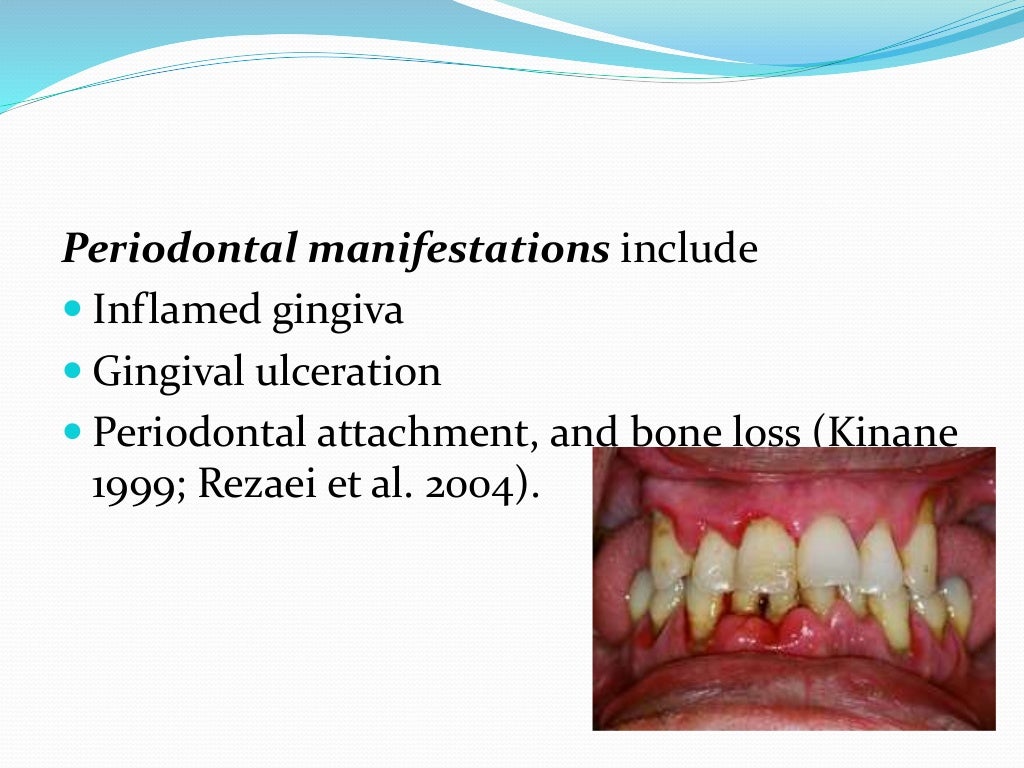 factors and periodontal disease