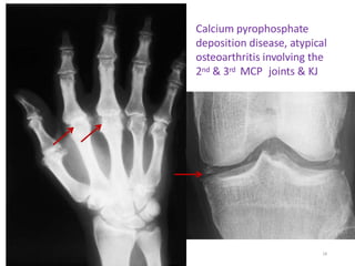 Calcium pyrophosphate
deposition disease, atypical
osteoarthritis involving the
2nd & 3rd MCP joints & KJ
18
 