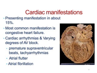 Cardiac manifestations
• Presenting manifestation in about
15%.
• Most common manifestation is
congestive heart failure.
• Cardiac arrhythmias & Varying
degrees of AV block.
• premature supraventricular
beats, tachyarrhythmias
• Atrial flutter
• Atrial fibrillation
19
 