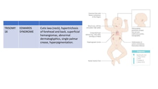 TRISOMY
18
EDWARDS
SYNDROME
Cutis laxa (neck), hypertrichosis
of forehead and back, superficial
hemangiomas, abnormal
dermatoglyphics, single palmar
crease, hyperpigmentation.
 