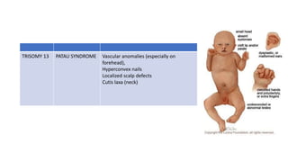 TRISOMY 13 PATAU SYNDROME Vascular anomalies (especially on
forehead),
Hyperconvex nails
Localized scalp defects
Cutis laxa (neck)
 