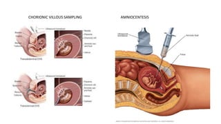CHORIONIC VILLOUS SAMPLING AMNIOCENTESIS
 