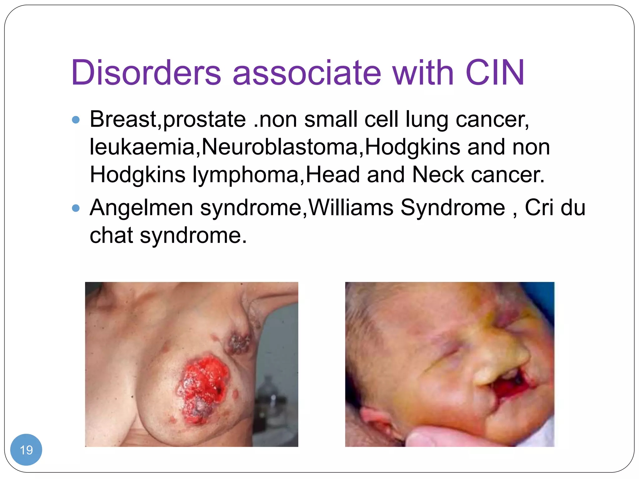 Disorders associate with CIN
19
 Breast,prostate .non small cell lung cancer,
leukaemia,Neuroblastoma,Hodgkins and non
Hodgkins lymphoma,Head and Neck cancer.
 Angelmen syndrome,Williams Syndrome , Cri du
chat syndrome.
 
