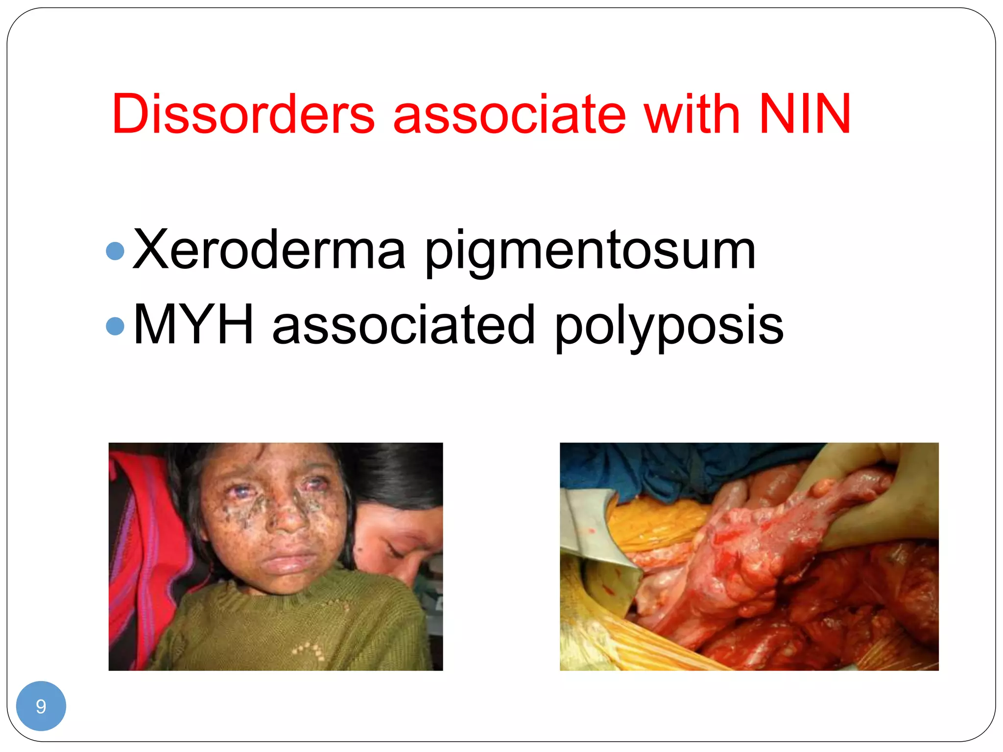 Dissorders associate with NIN
9
Xeroderma pigmentosum
MYH associated polyposis
 