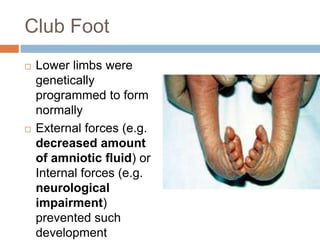 Club Foot
   Lower limbs were
    genetically
    programmed to form
    normally
   External forces (e.g.
    decreased amount
    of amniotic fluid) or
    Internal forces (e.g.
    neurological
    impairment)
    prevented such
    development
 