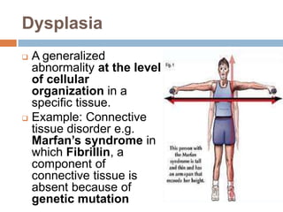 Dysplasia
 A generalized
  abnormality at the level
  of cellular
  organization in a
  specific tissue.
 Example: Connective
  tissue disorder e.g.
  Marfan’s syndrome in
  which Fibrillin, a
  component of
  connective tissue is
  absent because of
  genetic mutation
 