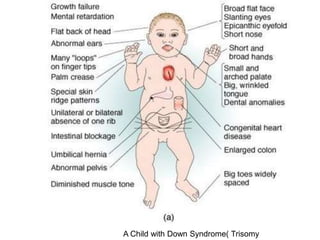 A Child with Down Syndrome( Trisomy
 